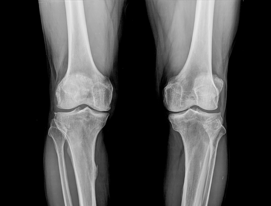Reeleer Gothic Knee Bone Orthopedic Ortho Nurse Myanmar